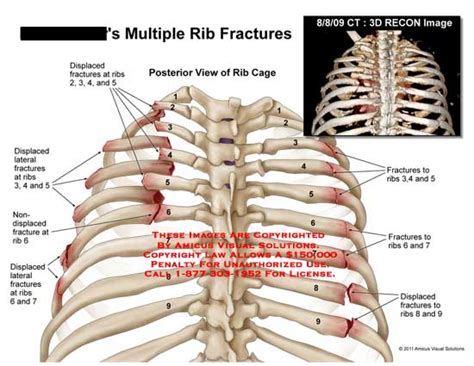 Multiple Rib Fractures