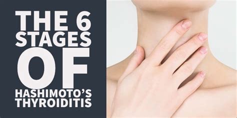 6 Stages Of Hashimotos Thyroiditis That All Patients Go Through