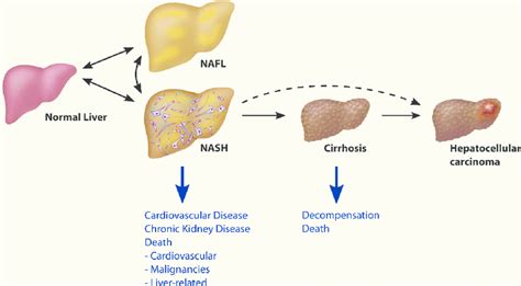 Non Alcoholic Liver Disease Nafld Spectrum Nafld Encompasses A