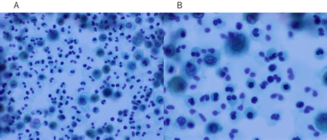 Eosinophilic Pneumonia Associated With Natalizumab In A Patient With M