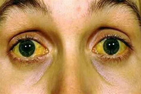 Learn about this condition, why it causes yellow eyes, and possible treatments. Jaundice - 5 Best Homeopathic Medicines for jaundice