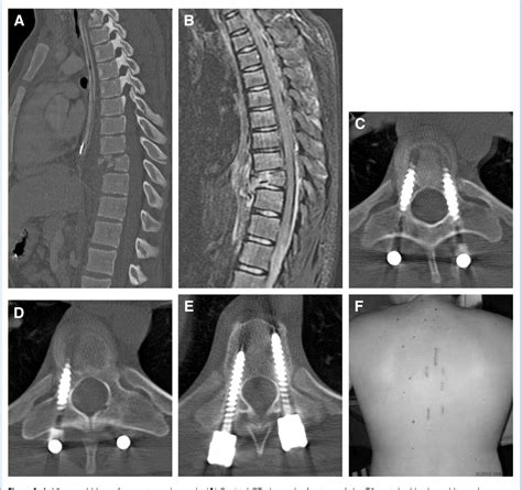 Figure From Placement Of Percutaneous Thoracic Pedicle Screws Using Neuronavigation