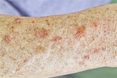 Actinic Keratosis Pictures Causes And Prevention