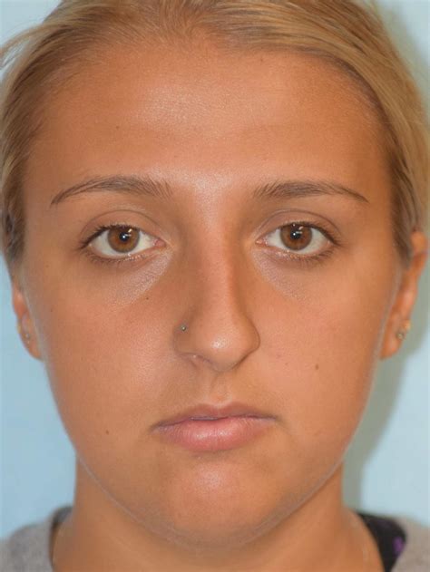 patient 36550413 rhinoplasty before and after photos frankel facial plastic surgery