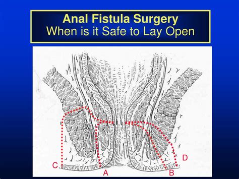 Ppt Fistulotomy And Setons Powerpoint Presentation Free Download