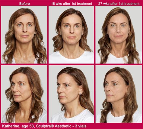 What Is Sculptra Capizzi Md