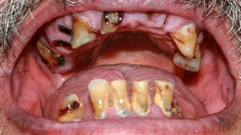 3 Year Old With Rotten Front Teeth Teethwalls