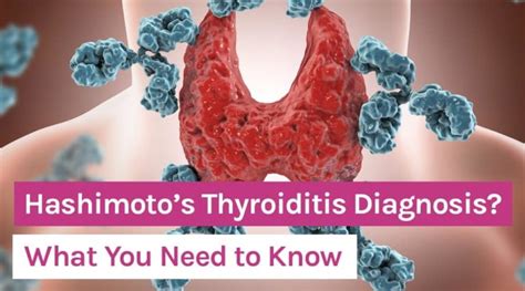 Hashimotos Thyroiditis Diagnosis What You Need To Know Organixx