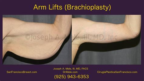 Arm Lifts Brachioplasty Sf Bay Area Youtube