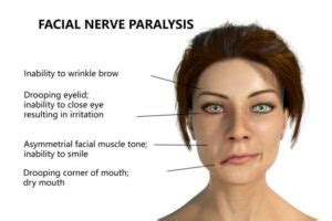 Facial Nerve Palsy Cause Symptoms Diagnosis Treatment Exercise