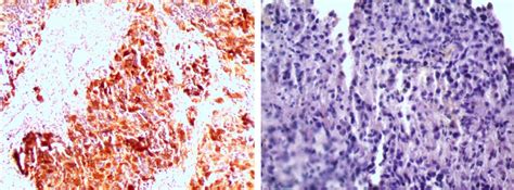Extra‐cns Metastasis Of Glioblastoma Multiforme To Cervical Lymph Nodes