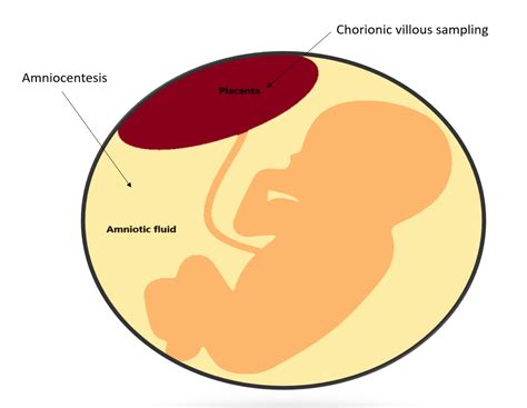 Invasive Prenatal Diagnosis Chorionic Villous Sampling And