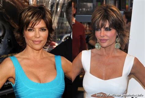 Lisa Rinna Before And After Lip Reduction Surgery Celebrity Plastic