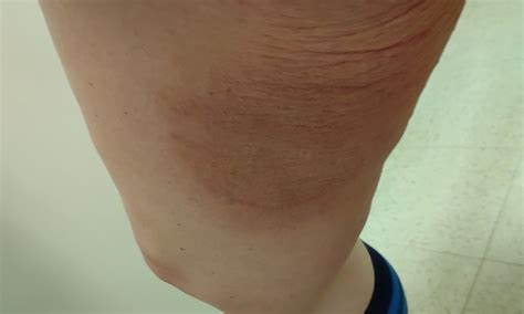 Dermdx Rash On Thigh Dermatology Advisor