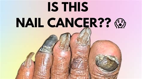 Skin Cancer Under Toenail