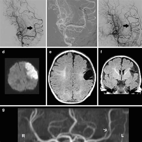 A Digital Subtraction Angiography DSA Occlusion Of The M Branch Of Download Scientific