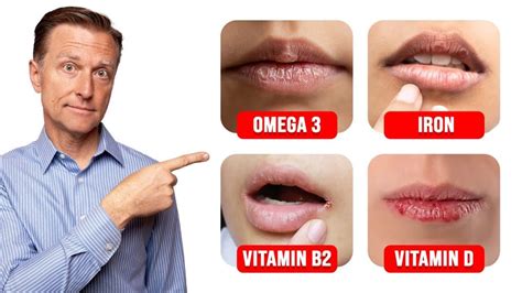 Dry Lips Vitamin Deficiency Best Life And Health Tips And Tricks
