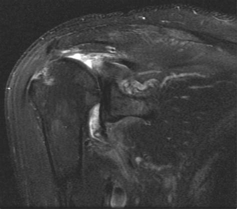 Suprascapular Neuropathy In Massive Rotator Cuff Tears With Severe