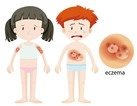 Dermatita Atopica Eczema Totul De La Cauze La Tratament LEM