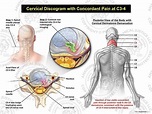 Male Left Cervical Discogram with Concordant Pain at C3-4