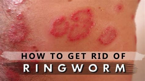 How To Get Rid Of Ringworm With Home Remedies Fast Wringworm Treatment