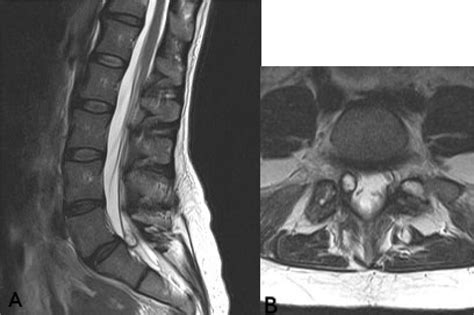 Minimally Invasive Surgery For Lumbar Synovial Cysts With Coexisting