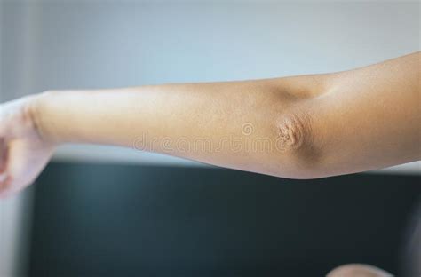 Close Up Of Woman With Dry Skin On Elbow And Armbody And Health Care