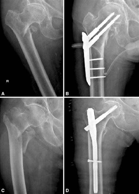 Pertrochanteric Femur Fracture