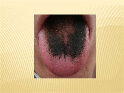 Diseases Of Tongue