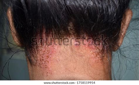 Seborrheic Dermatitis Fungal Skin Infection Scalp Stock Photo