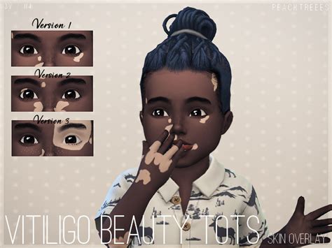 Vitiligo Beauty Skin Overlay Toddlers N4 Emily Cc Finds