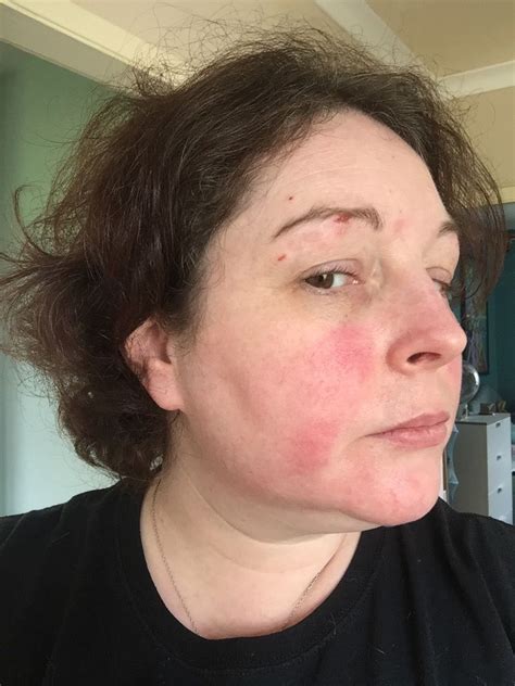 Lupus Butterfly Rash On Face