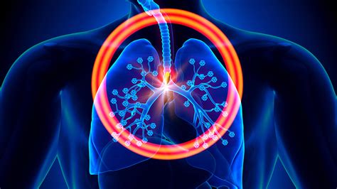 How Lung Cancer Progresses By Stage | Eveyday Health