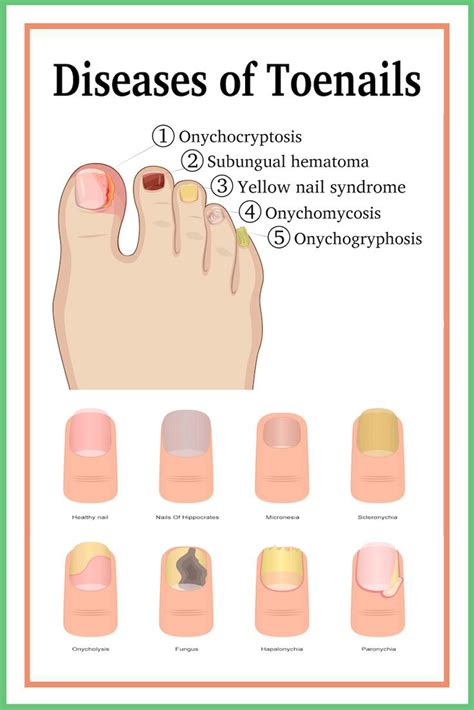 Nail Problems What Does Your Nail Appearance Say About Your Health