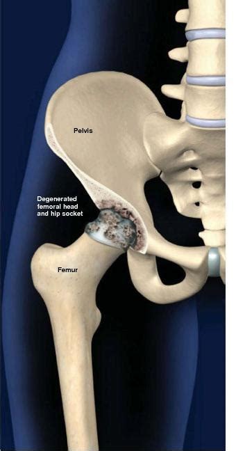 Degenerative Joint Disease Of The Hip Osteoarthritis Of The Hip