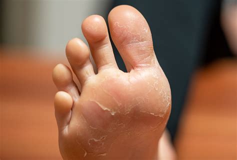 peeling skin on feet causes home remedies and prevention
