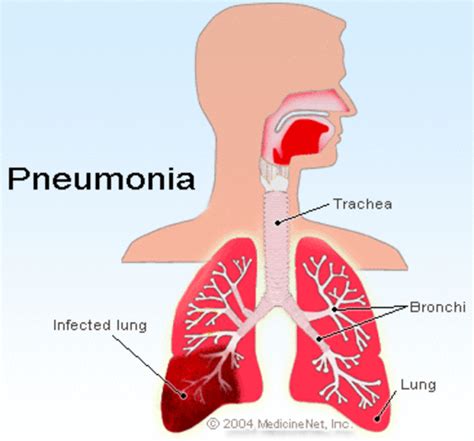 Pneumonia Timeline Timetoast Timelines