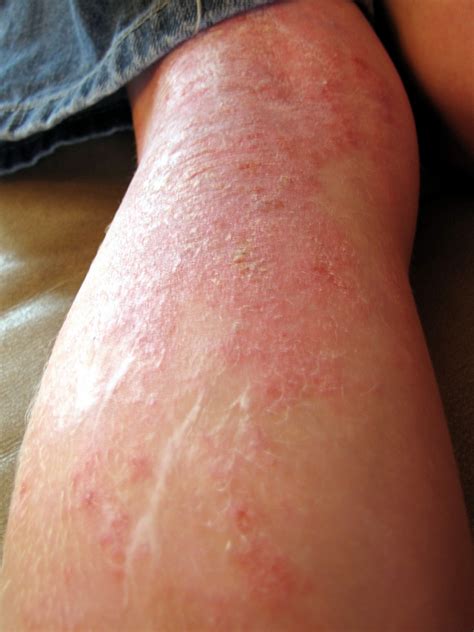 Suffering From Eczema Put An End To The Misery Now Keys Of Health