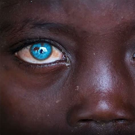 Watch Dark Skin And Dazzling Blue Eyes Phenomenon Africa