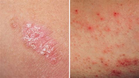 Key Differences Between Eczema And Psoriasis