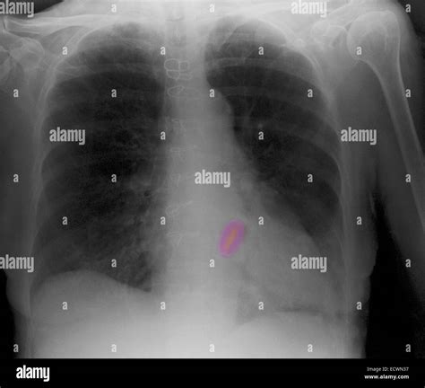 Cardiac Valves Chest X Ray