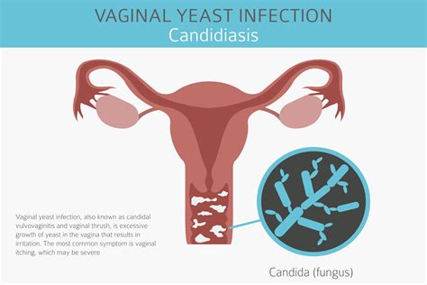 Yeast Infections In Women Buckhead Urgent Care Atlanta Ga