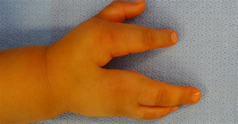 Cleft Hand Surgery Congenital Hand And Arm Differences