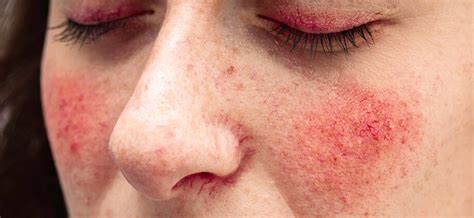 Rosacea Or Redness On The Face What It Is And How To Get Rid Of It
