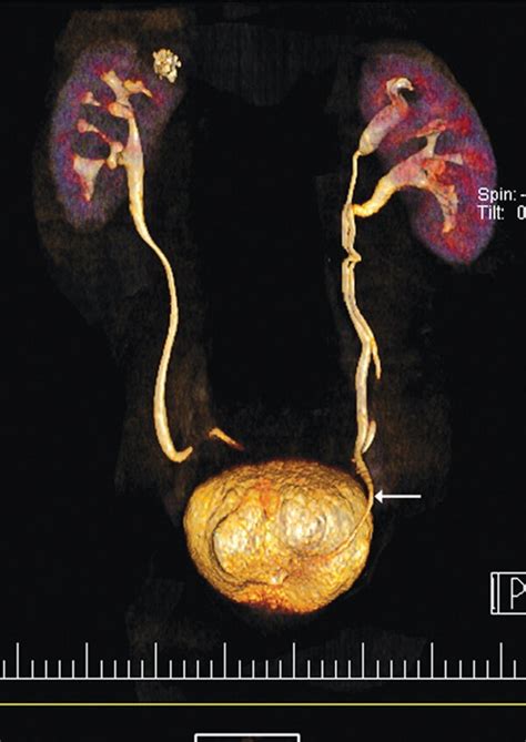 Ct Urogram Showing Duplex Ie With Double Ureters Left Kidney The