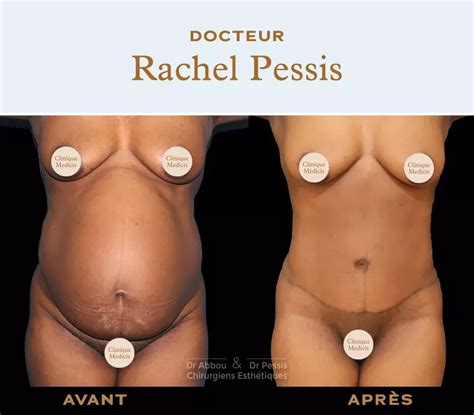 Diastasis Recti Repair Paris Dr ABBOU And Dr PESSIS