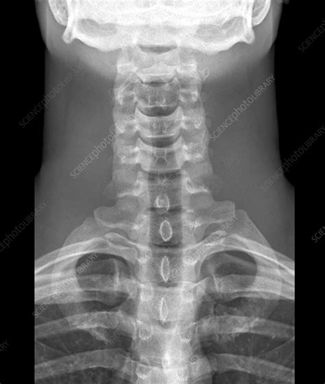 Normal Neck X Ray Stock Image F0033508 Science Photo Library
