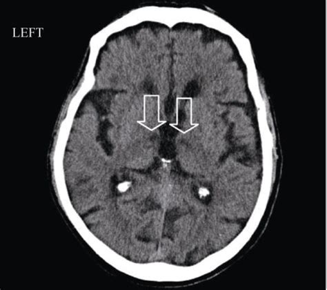 Figure 1 From Patent Foramen Ovale In An Old Patient With Ischemic