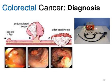 Bowel cancer is another name for cancer of the colon or small intestines. Colon cancer