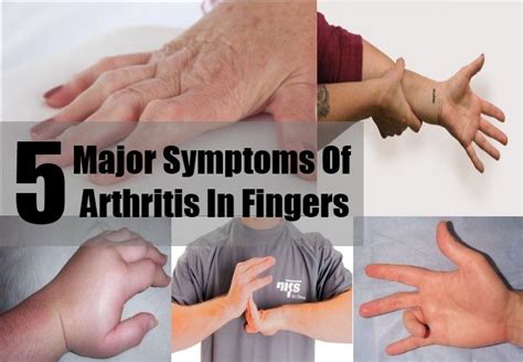 5 Major Symptoms Of Arthritis In Fingers Arthritis In Fingers